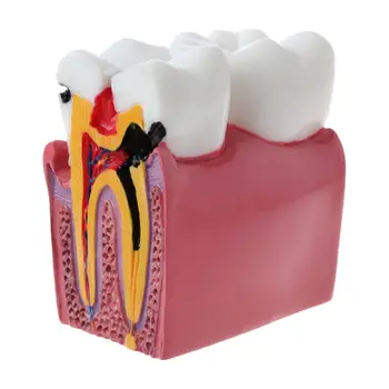 De 6 Ori Cariilor Dentare Comparatie Anatomia Dinților Model de Anatomie Dentara Laboratorul de Predare Studierea Cercetarea Instrument